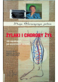 Żylaki i choroby żył