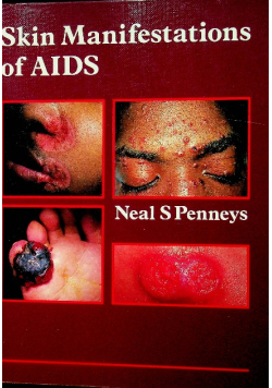 Skin Manifestations of Aids