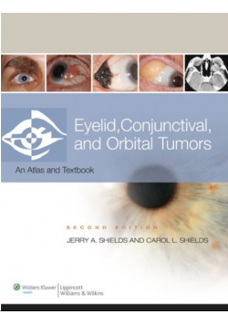 Eyelid Conjunctival and Orbital Tumors