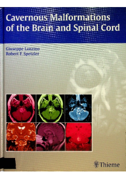 Cavernous Malformations of the Brain and Spinal Cord