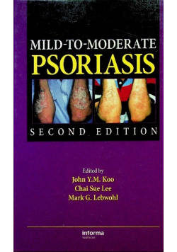 Mild moderate psoriasis
